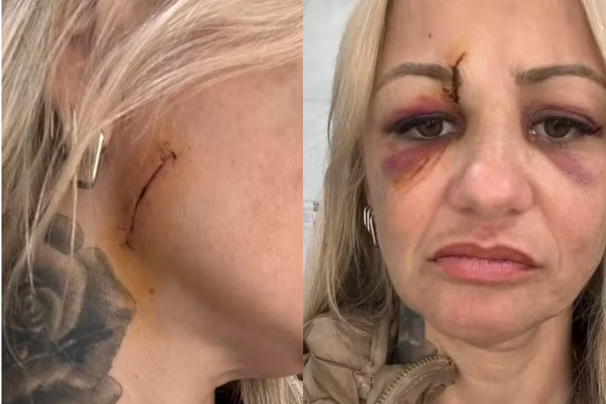 MULHER AGREDIDA PG Mulher é agredida e leva 20 pontos no rosto em Praia Grande