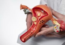 Endometriose pode levar 7 anos para ser diagnosticada e ameaçar a fertilidade
